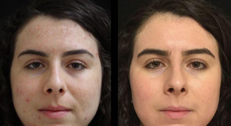 Before &After